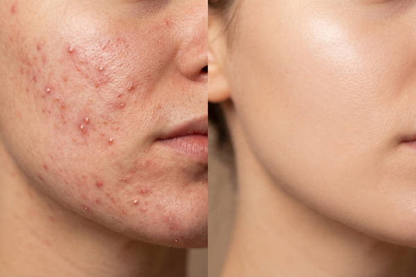 Fights Acne and Bacteria While You Sleep